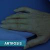 tratamiento-artrosis-santander